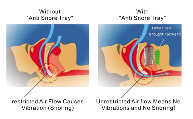 Anti Snore Soft Silicone Mouthpiece Stop Snoring Solution